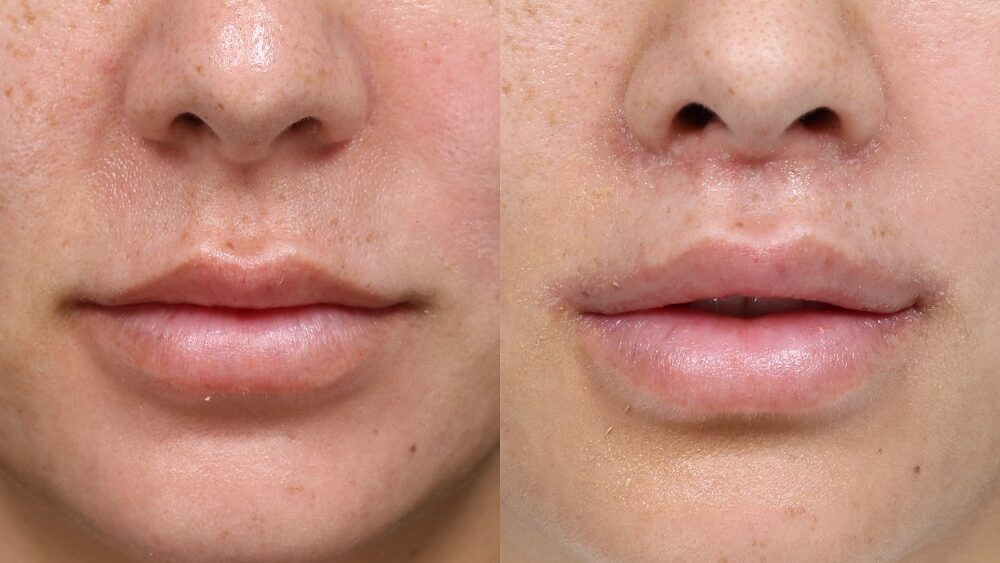 Lip before/after