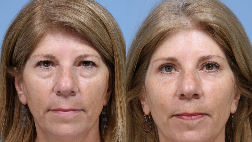 Before/after of an upper bleph patient