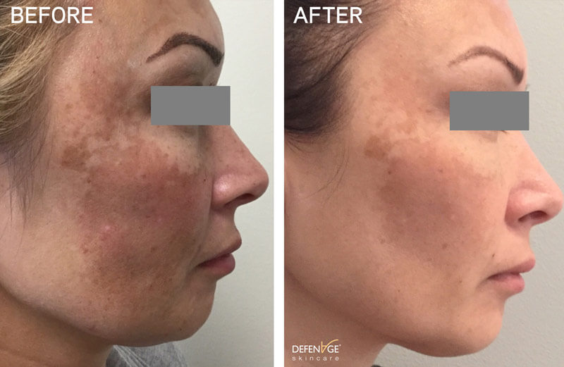 DefenAge Before/After