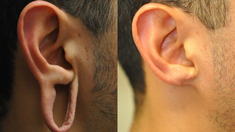 Before/after of loose earlobes