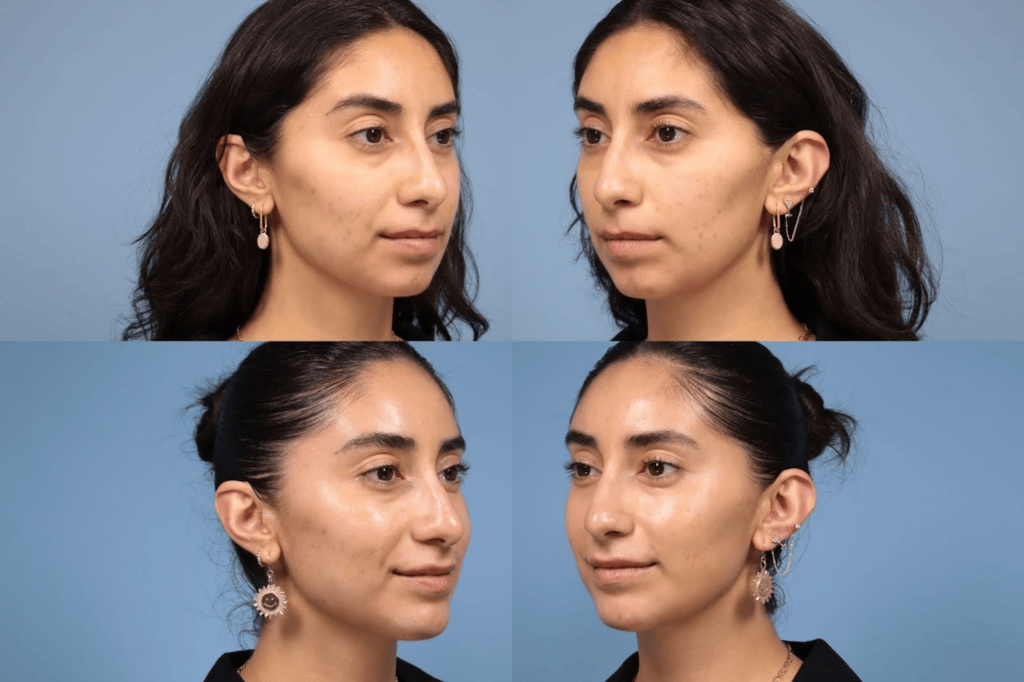 Before and After of L&P Aesthetics patient who underwent a full face rejuvenation using filler