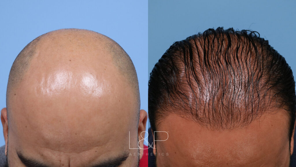 Before and after of a hair transplant