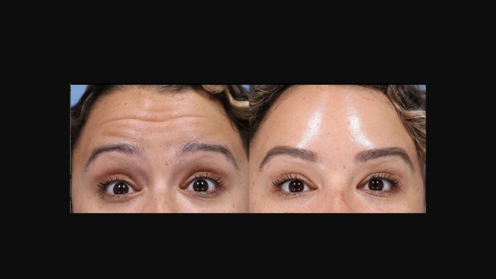 Baby botox at L&P Aesthetics