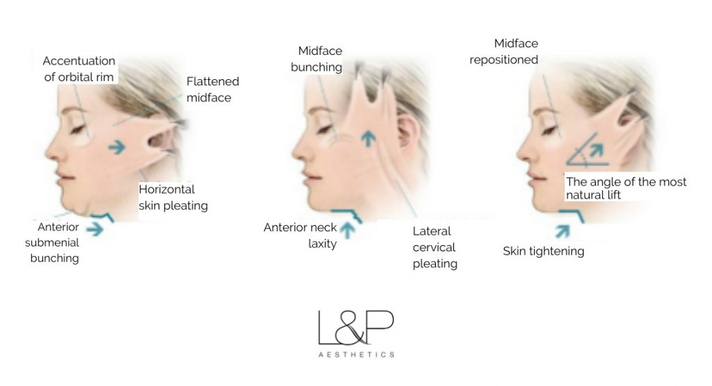 Facelift Treatment illustration