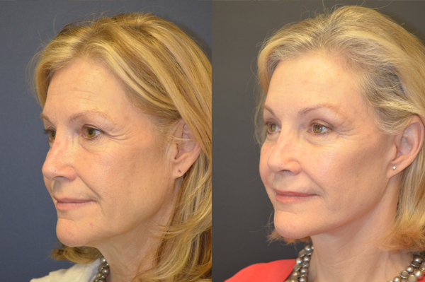 Becky Before After treatment