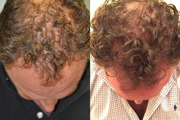 Before After Andrew treatment