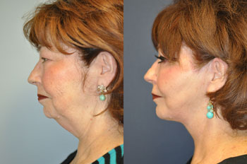 Cherrell Before After treatment