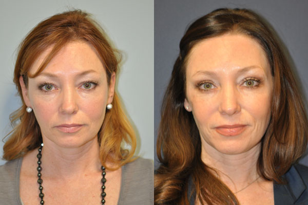 Marla Before After treatment