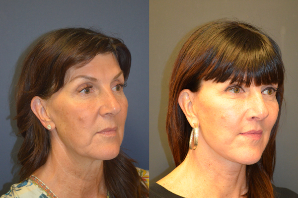 Melissa Before After treatment
