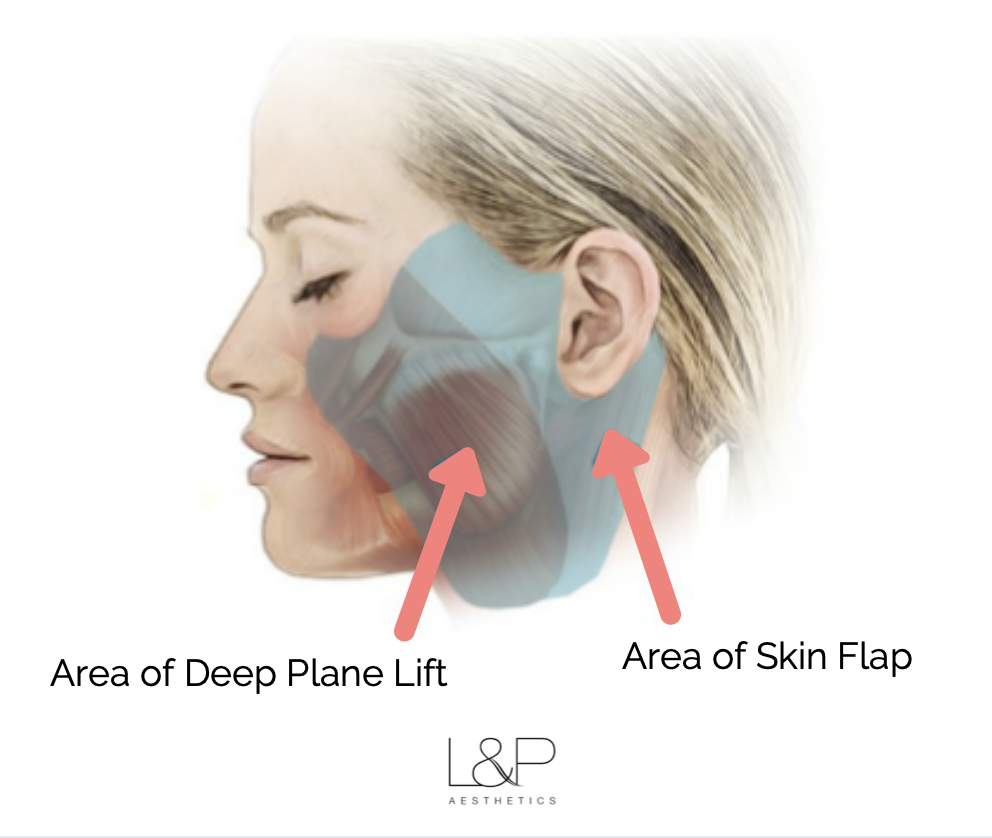 Facelift Treatment illustration