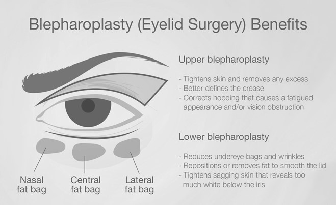 Blepharoplasty Procedure illustration