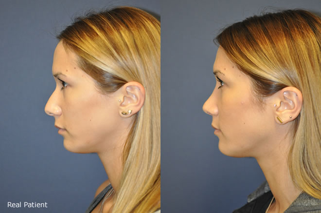 lindsey Before After treatment
