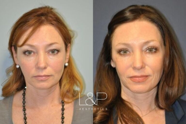 Female Blepharoplasty before and after procedure at L&P Aesthetics in Palo Alto