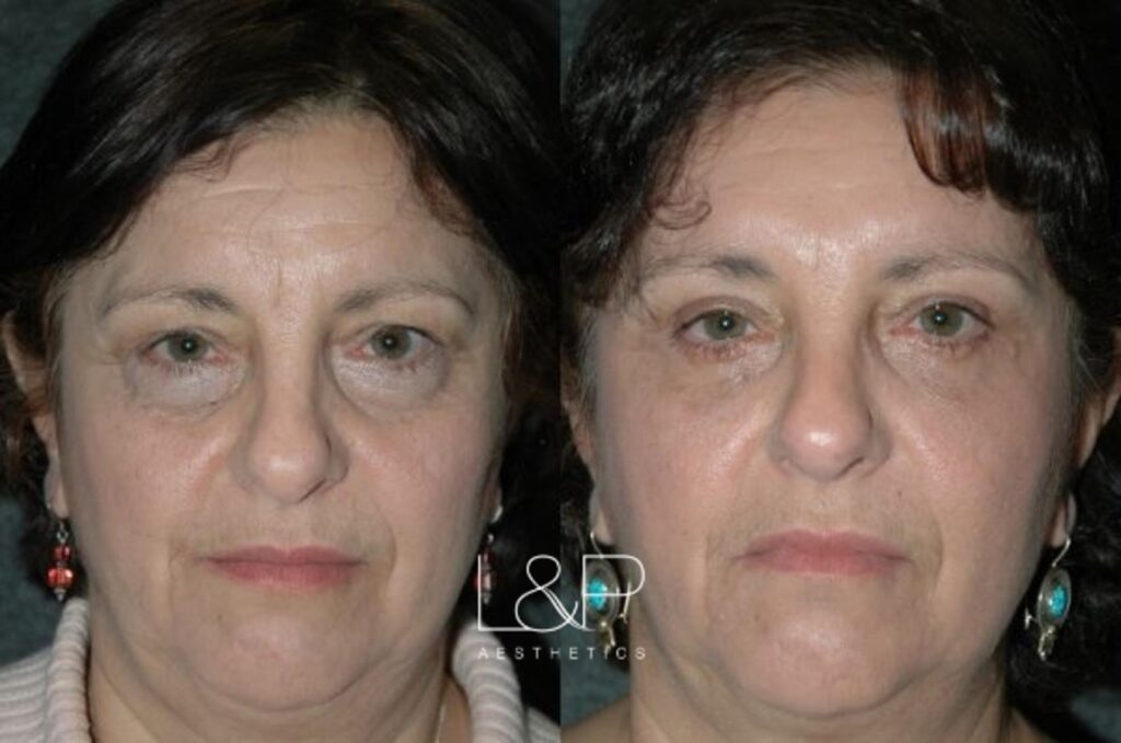 Female Blepharoplasty before and after treatment at L&P Aesthetics in the Bay Area