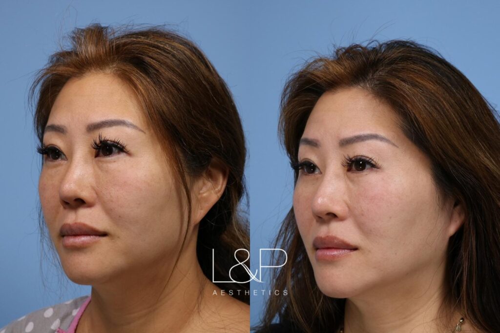 Lower eyelid lift with fat transposition before and after treatment at L&P Aesthetics in Palo Alto