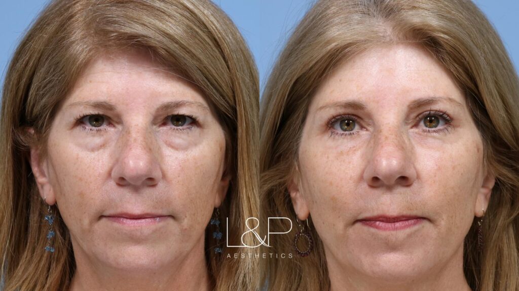 Upper and lower blepharoplasty with brow lift female patient before and after treatment in the Bay Area at L&P Aesthetics