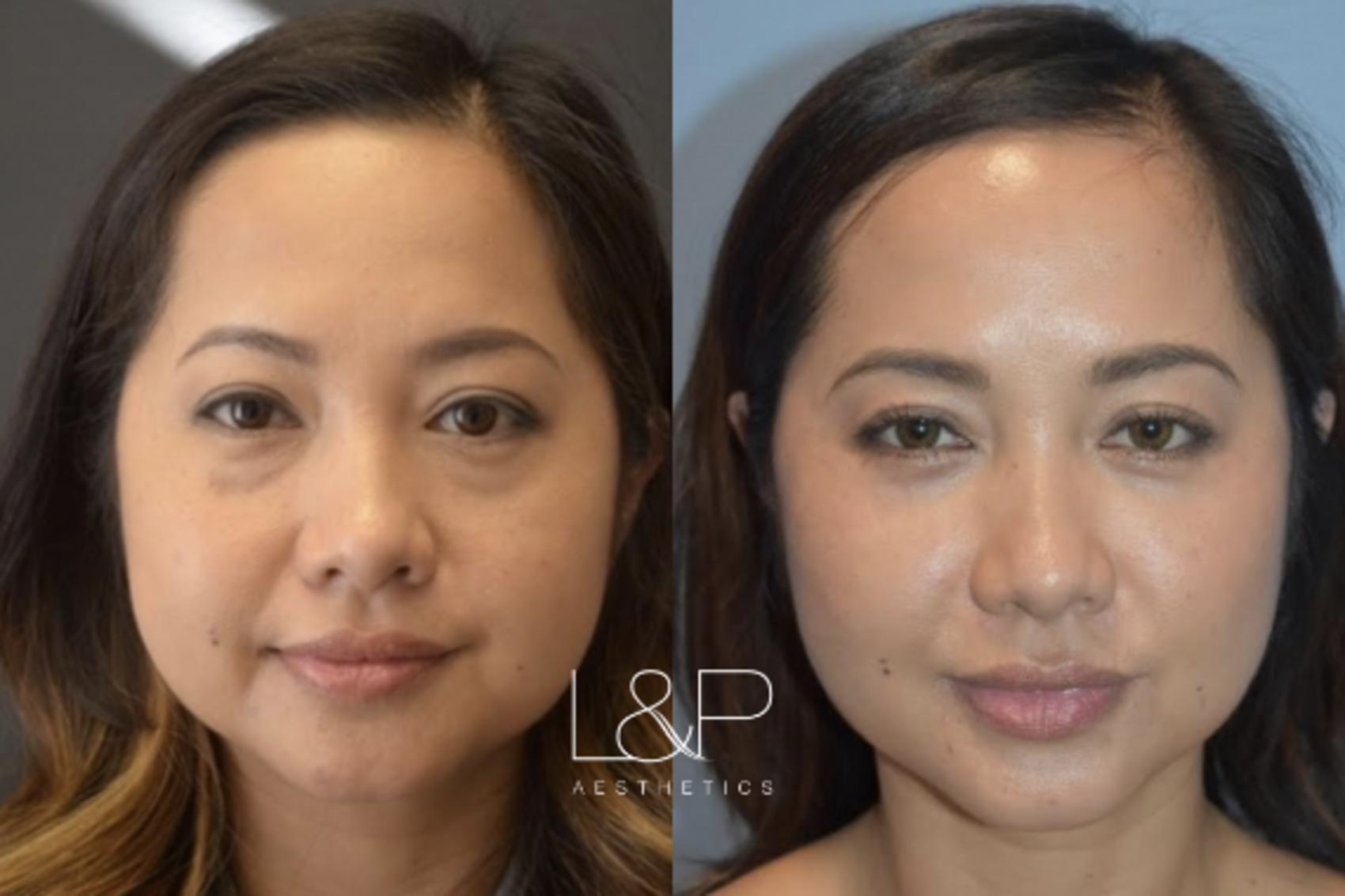Female Lower Blepharoplasty before and after procedure