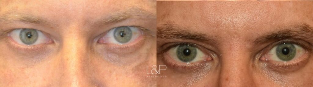 Upper blepharoplasty male patient before and after treatment at L&P Aesthetics in Palo Alto