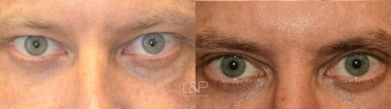 Upper blepharoplasty male patient before and after treatment at L&P Aesthetics in Palo Alto