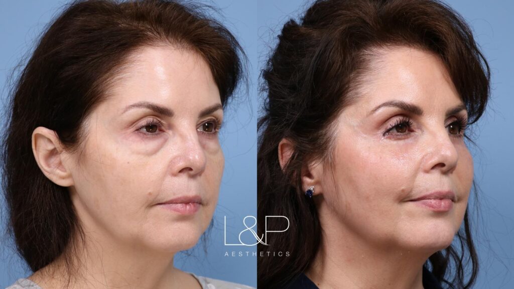 Upper blepharoplasty female patient before and after treatment at L&P Aesthetics in Palo Alto