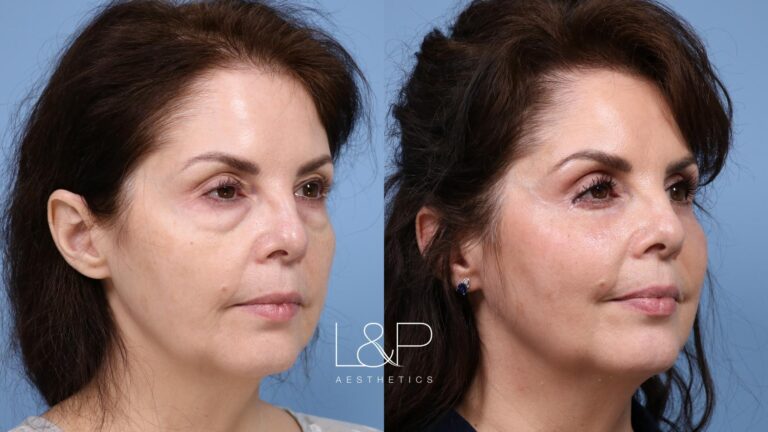 Upper blepharoplasty female patient before and after treatment at L&P Aesthetics in Palo Alto