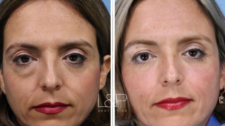 Lower blepharoplasty and fat transfer female patient before and after treatment at L&P Aesthetics in Palo Alto