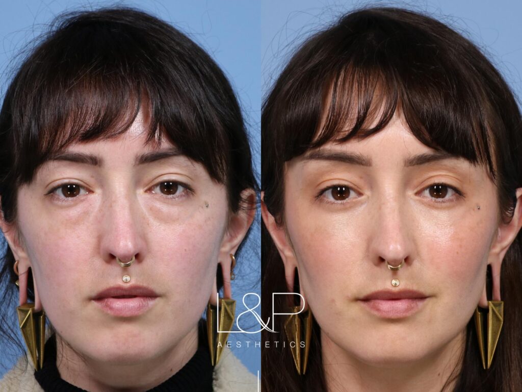 Blepharoplasty and fat transfer before and after treatment at L&P Aesthetics in the Bay Area