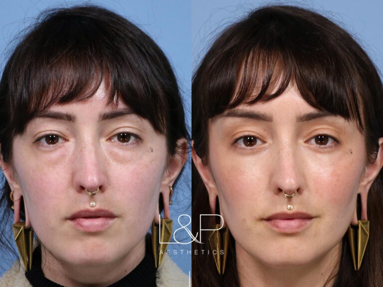 Blepharoplasty and fat transfer before and after treatment at L&P Aesthetics in the Bay Area