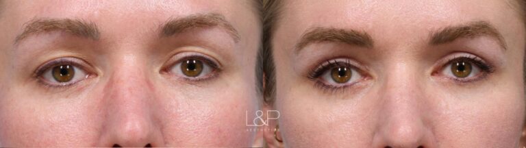 Upper blepharoplasty before and after treatment at L&P Aesthetics in the Bay Area