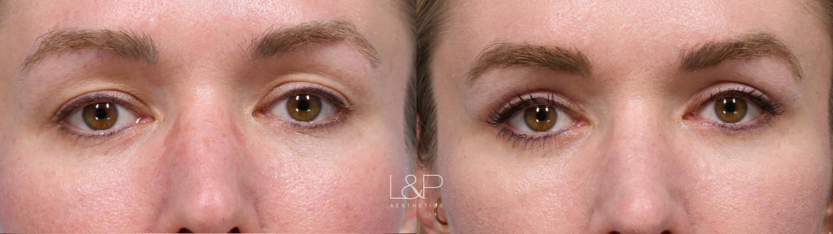 Upper blepharoplasty before and after treatment at L&P Aesthetics in the Bay Area