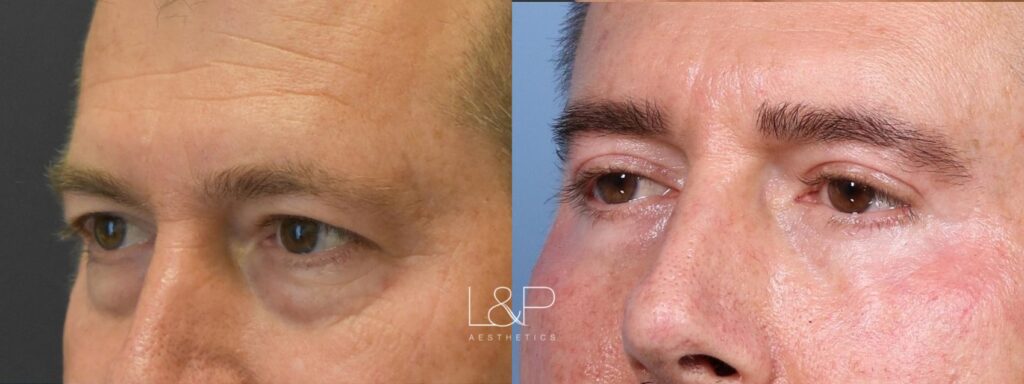 Upper and lower blepharoplasty before and after treatment at L&P Aesthetics in Palo Alto