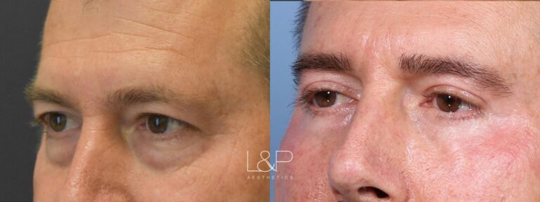 Upper and lower blepharoplasty before and after treatment at L&P Aesthetics in Palo Alto