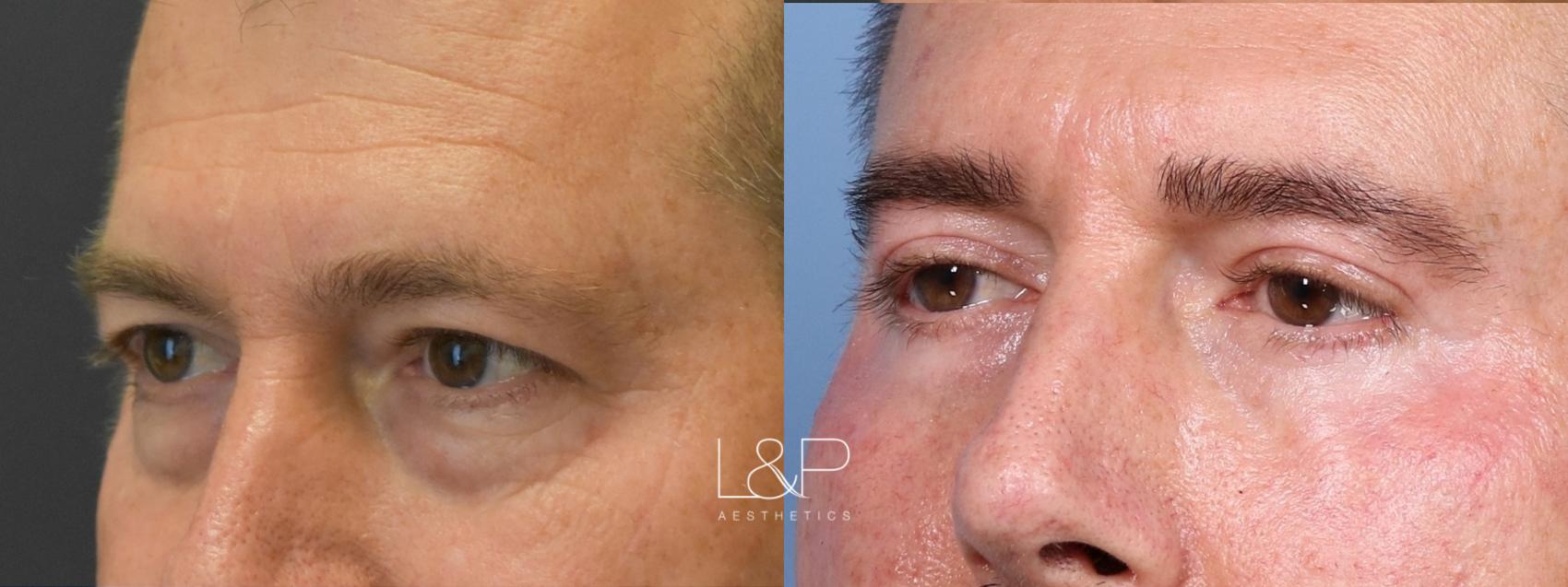 Upper and lower blepharoplasty before and after treatment at L&P Aesthetics in Palo Alto