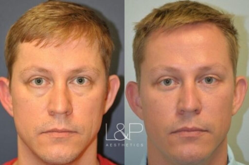 Blepharoplasty and brow lift before and after treatment in Los Gatos, California