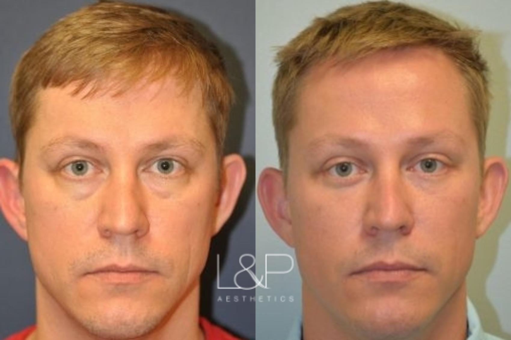 Blepharoplasty and brow lift before and after treatment in Los Gatos, California
