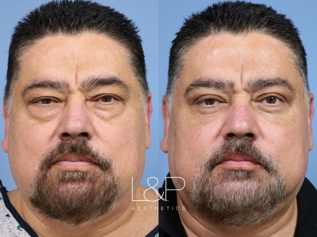 Upper and lower blepharoplasty before and after treatment at L&P Aesthetics in Palo Alto