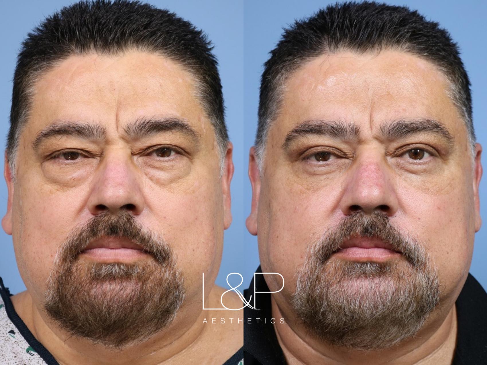Upper and lower blepharoplasty before and after treatment at L&P Aesthetics in Palo Alto
