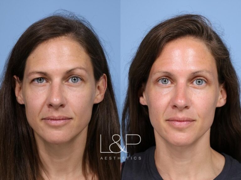 Upper blepharoplasty and endoscopic brow lift female patient before and after treatment in Palo Alto, California at L&P Aesthetics