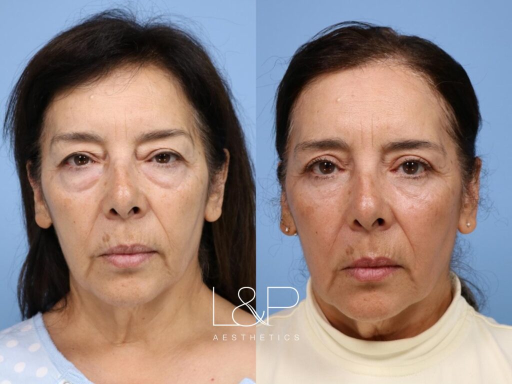 Upper and lower blepharoplasty with fat transfer female patient before and after treatment at L&P Aesthetics in Palo Alto