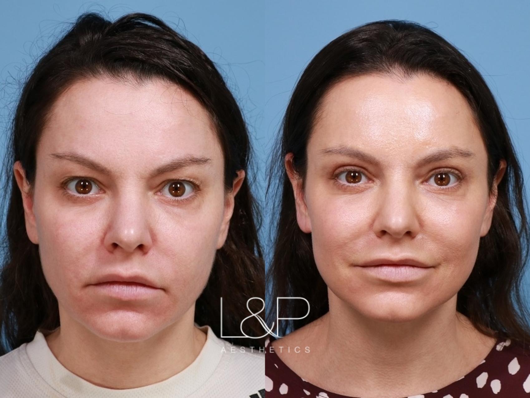 Upper blepharoplasty female patient before and after treatment at L&P Aesthetics in Palo Alto