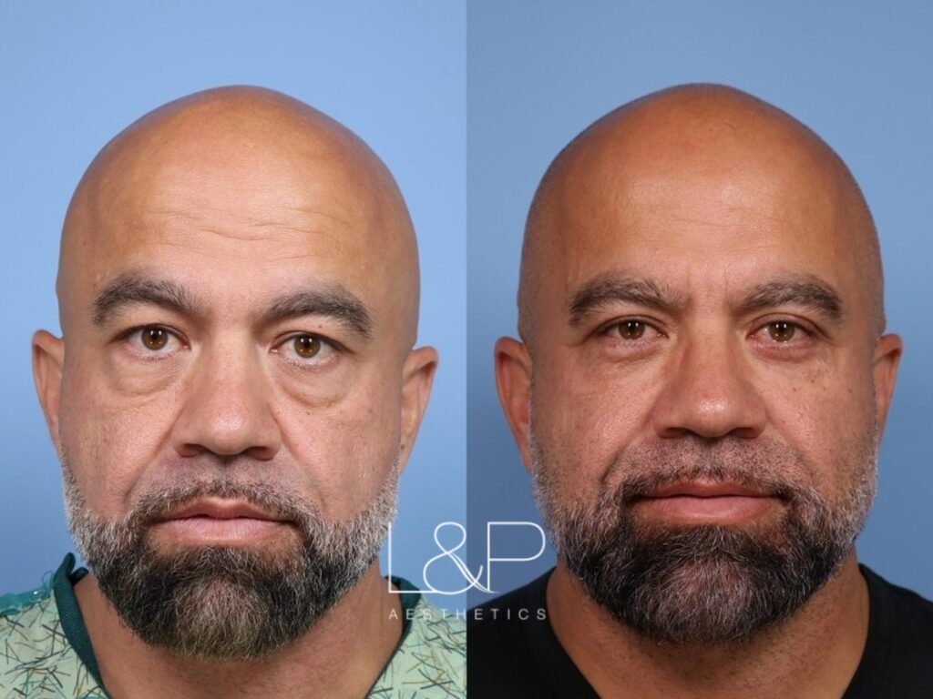 Upper and lower blepharoplasty and Sculptra injections on male patient before and after treatment at L&P Aesthetics