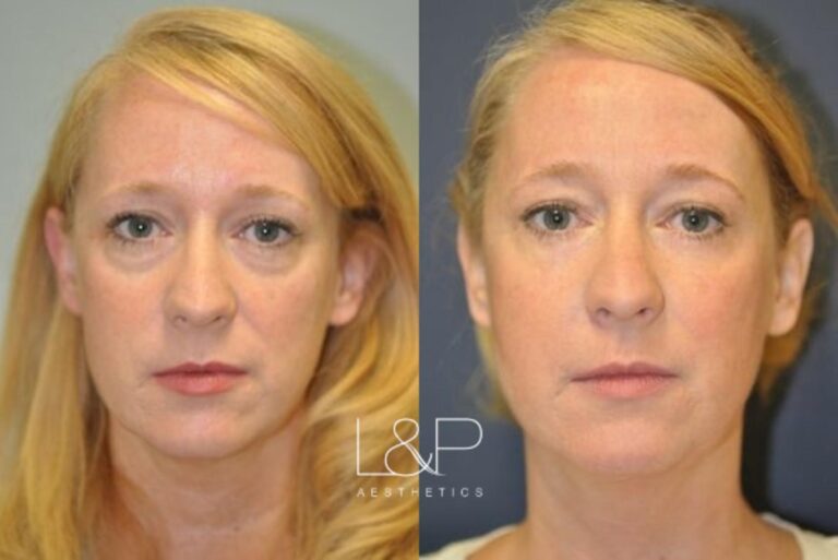 Lower eyelid blepharoplasty female patient before and after procedure at L&P Aesthetics in Palo Alto