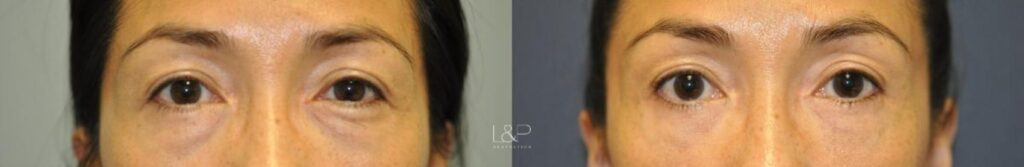 Blepharoplasty using a fat transposition technique before and after treatment