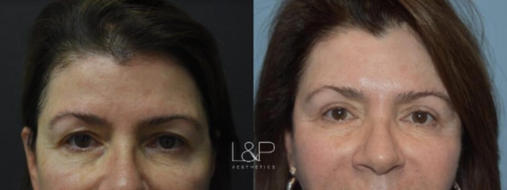 Upper blepharoplasty Female Patient before and after treatment at L&P Aesthetics in Palo Alto