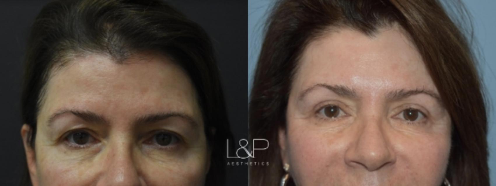 Upper blepharoplasty Female Patient before and after treatment at L&P Aesthetics in Palo Alto
