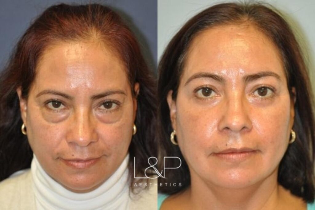 Lower blepharoplasty female patient before and after treatment at L&P Aesthetics in Palo Alto