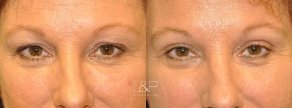 Upper eyelid female blepharoplasty before and after treatment