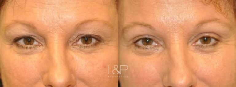 Upper eyelid female blepharoplasty before and after treatment