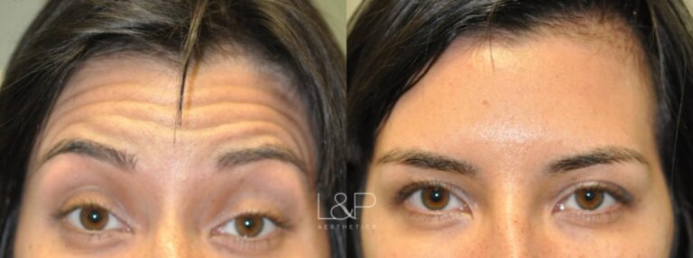 Botox Cosmetic before and after treatment