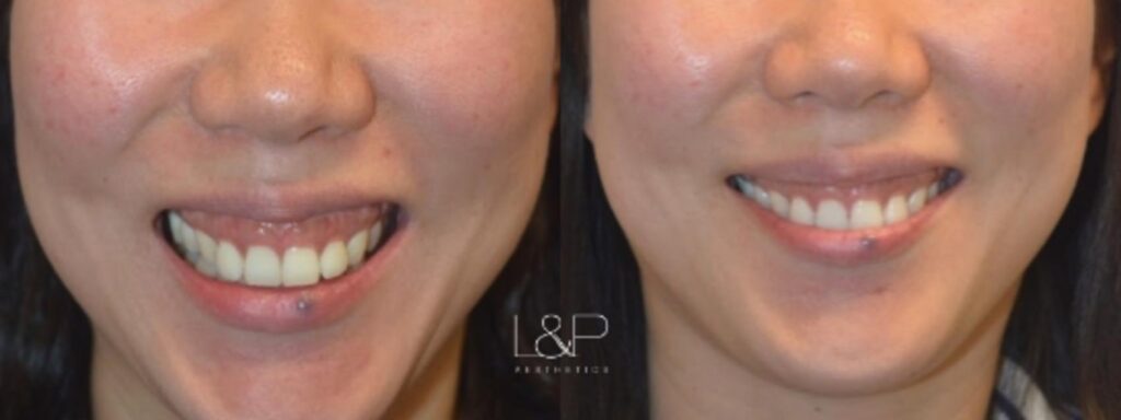 Botox Cosmetic before and after treatment
